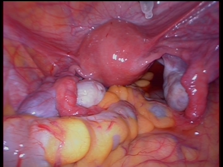 Laparoscopy Pelvis Laparoscopy Pelvis
